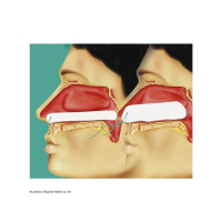 Raucocel Epistaxis 100mm EPIS100  10 St&uuml;ck