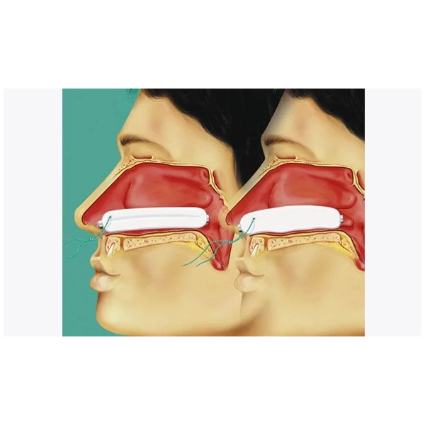 Raucocel-Nasentamponaden 80mm NAT80F 10 St&uuml;ck