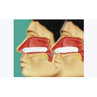 Raucocel-Nasentamponaden 80mm NAT80F 10 St&uuml;ck