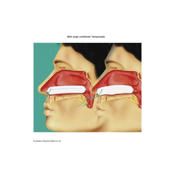 Raucocel-Nasentamponaden 80mm ventiliert 10 St&uuml;ck