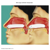 Raucocel-Nasentamponaden 80mm ventiliert 10 St&uuml;ck
